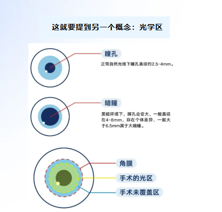 同样做近视手术，为啥有人会眩光？暗瞳是关键