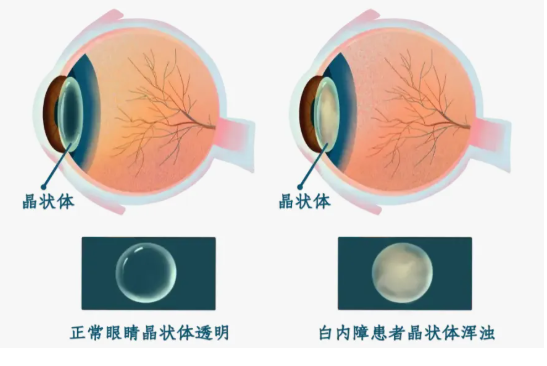 给眼睛“拨开迷雾”:一文读懂白内障的分类