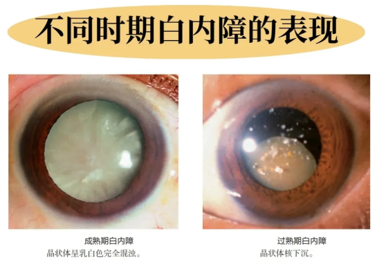 给眼睛“拨开迷雾”:一文读懂白内障的分类