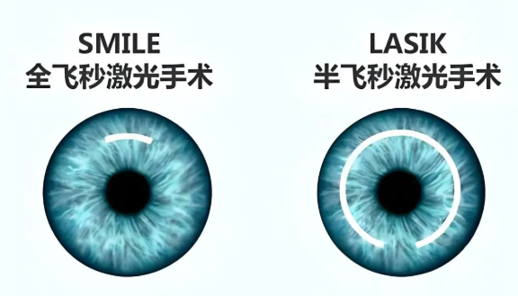 近视+散光双重困扰,现代科技:快速手术同步解决