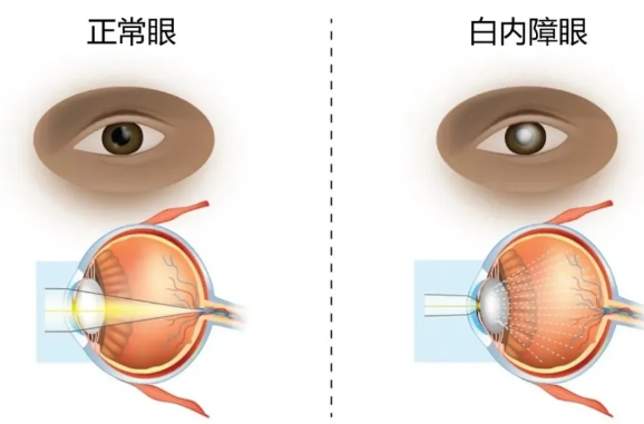 眼睛起雾了?关于白内障,看这一篇就够了!